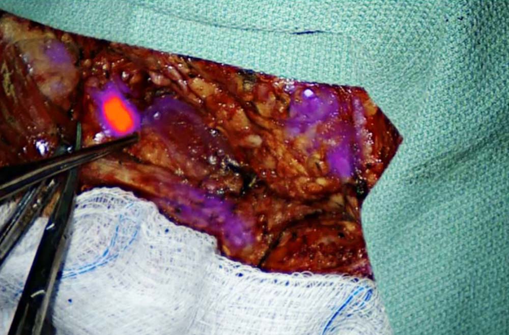 glowing tumor